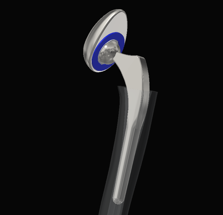 Hip Implant Model 2